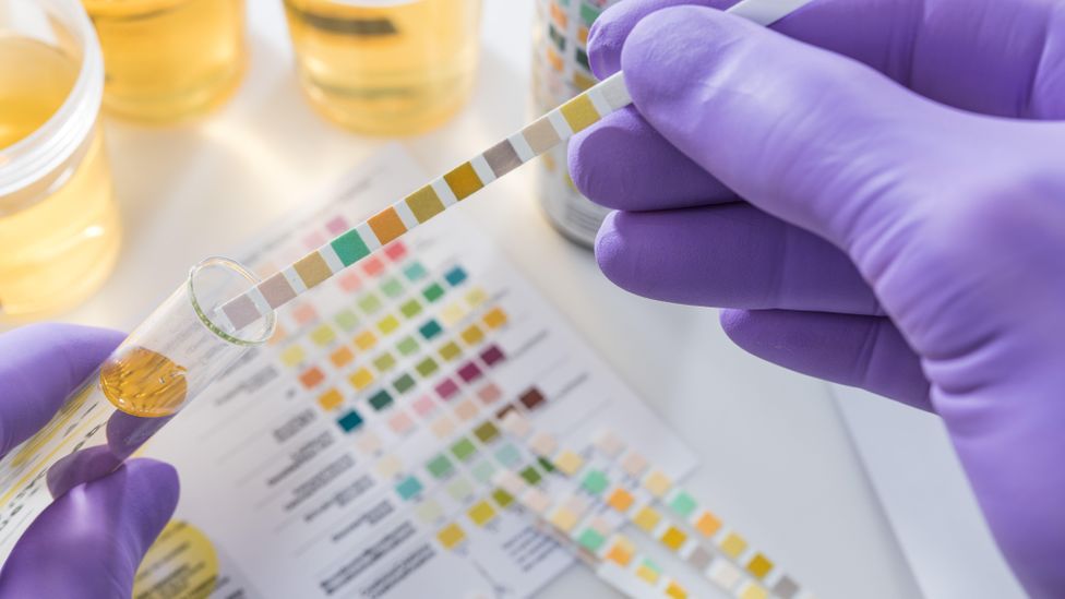 A urine sample being checked with a test strip (Credit: Alamy)